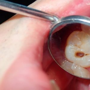 Enquête ReCol révolutionnaire : Diagnostiquer et éliminer les caries rapidement! enquete recol caries