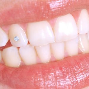 Tendance TikTok Strass dentaire : Pourquoi les dentistes sont-ils alarmés? strass dentaire tiktok