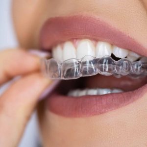 Choc : L'orthodontie dévoyée - Découvrez comment les traitements sont alignement dentaire