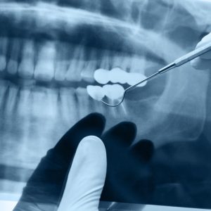 Parodontite : Régénération osseuse miracle grâce aux Macrolides ! Découvrez macrolides regeneration osseuse