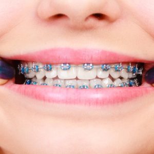 ALERTE: Ados CUSTOMISENT leurs Appareils Dentaires! Tendance DANGEREUSE "Fashion Braces" « Fashion braces » : la dangereuse tendance des adolescents à customiser leurs appareils dentaires