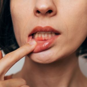 Parodontite & marqueurs sanguins dégradés : révélation choc d'une étude La parodontite associée à des niveaux de marqueurs sanguins dégradés selon une étude